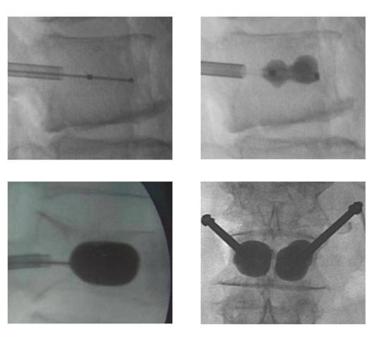 imagenes radiológicas de una vertebroplastia